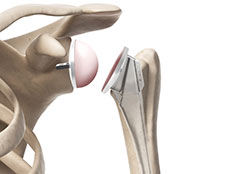 reverse artificial shoulder joint anatomy