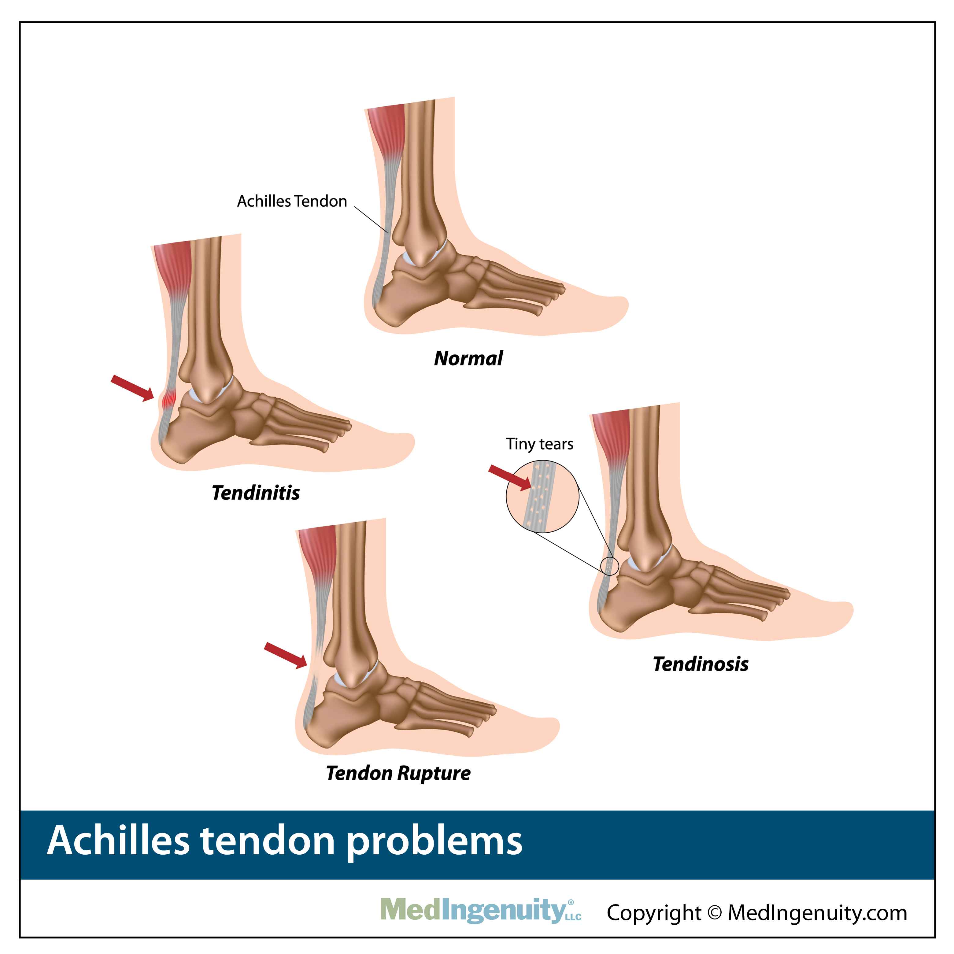 anatomy achilles tendon problems