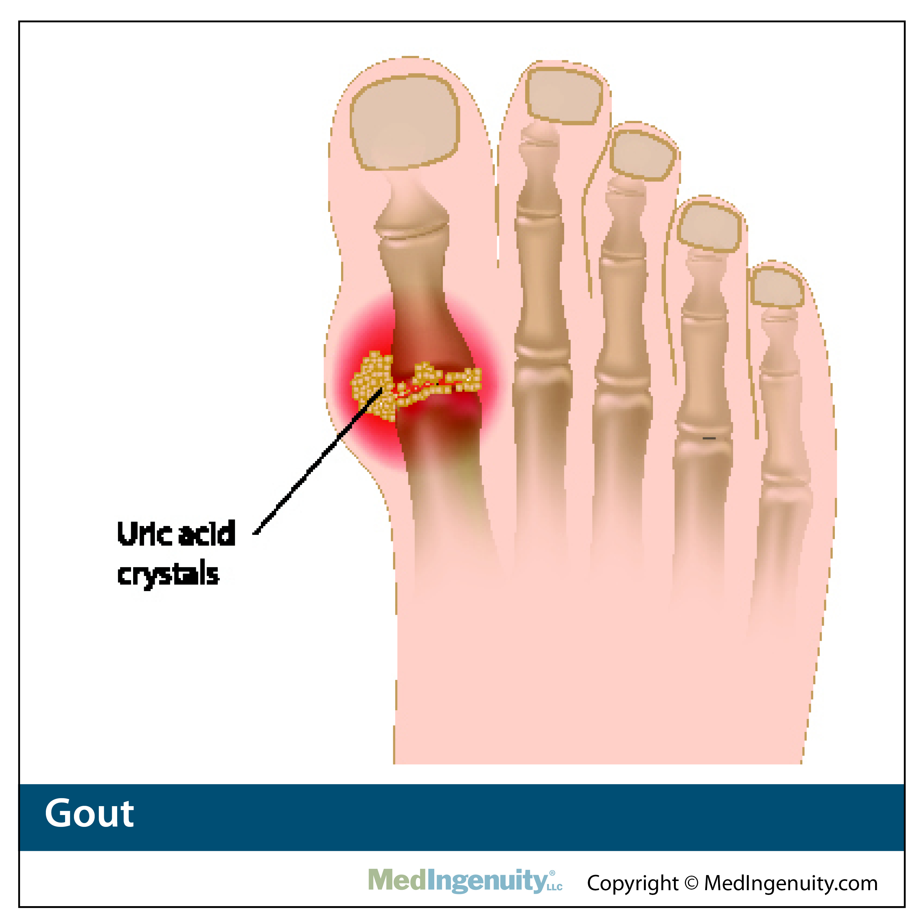 anatomy of Foot with gout