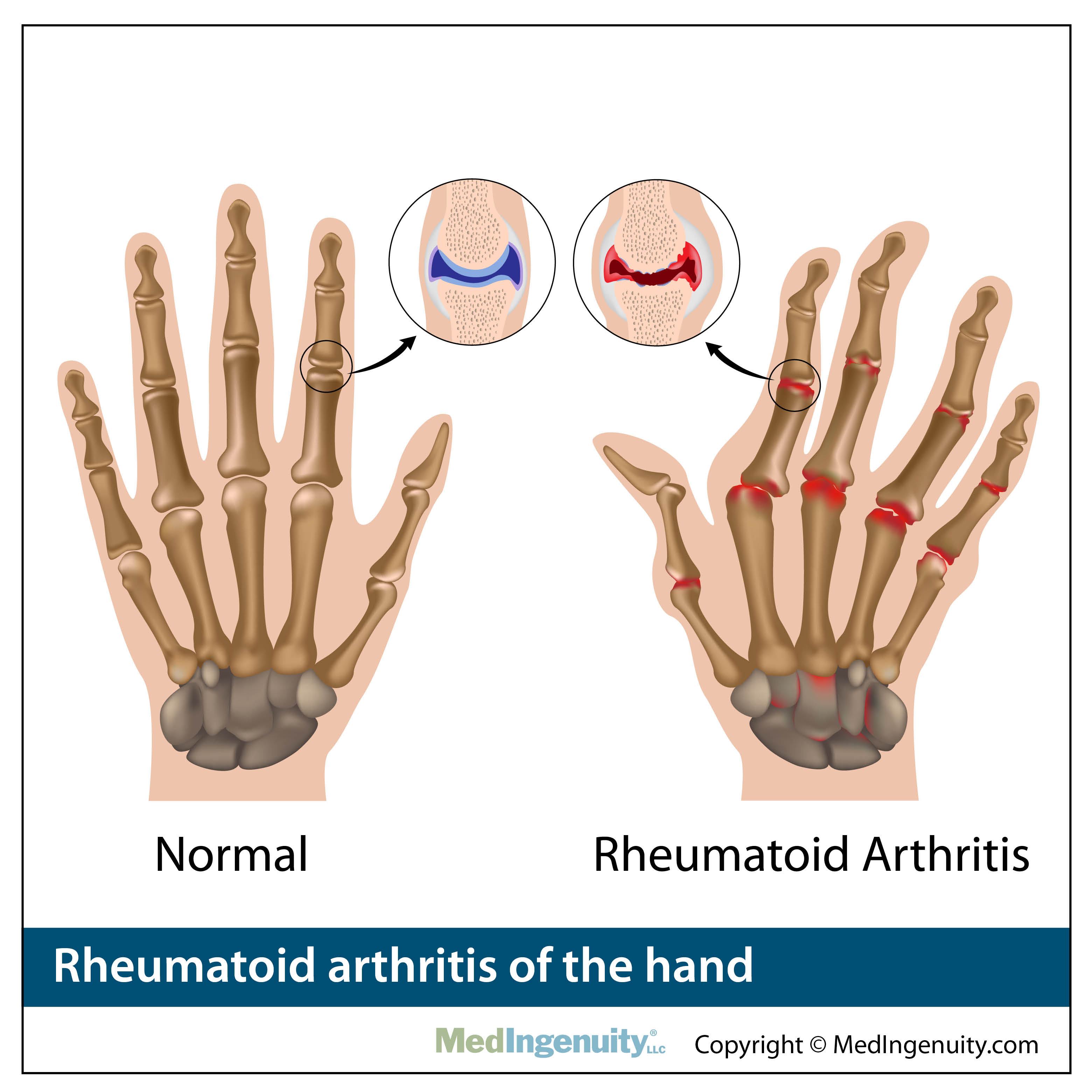 normal vs arthritic hand anatomy