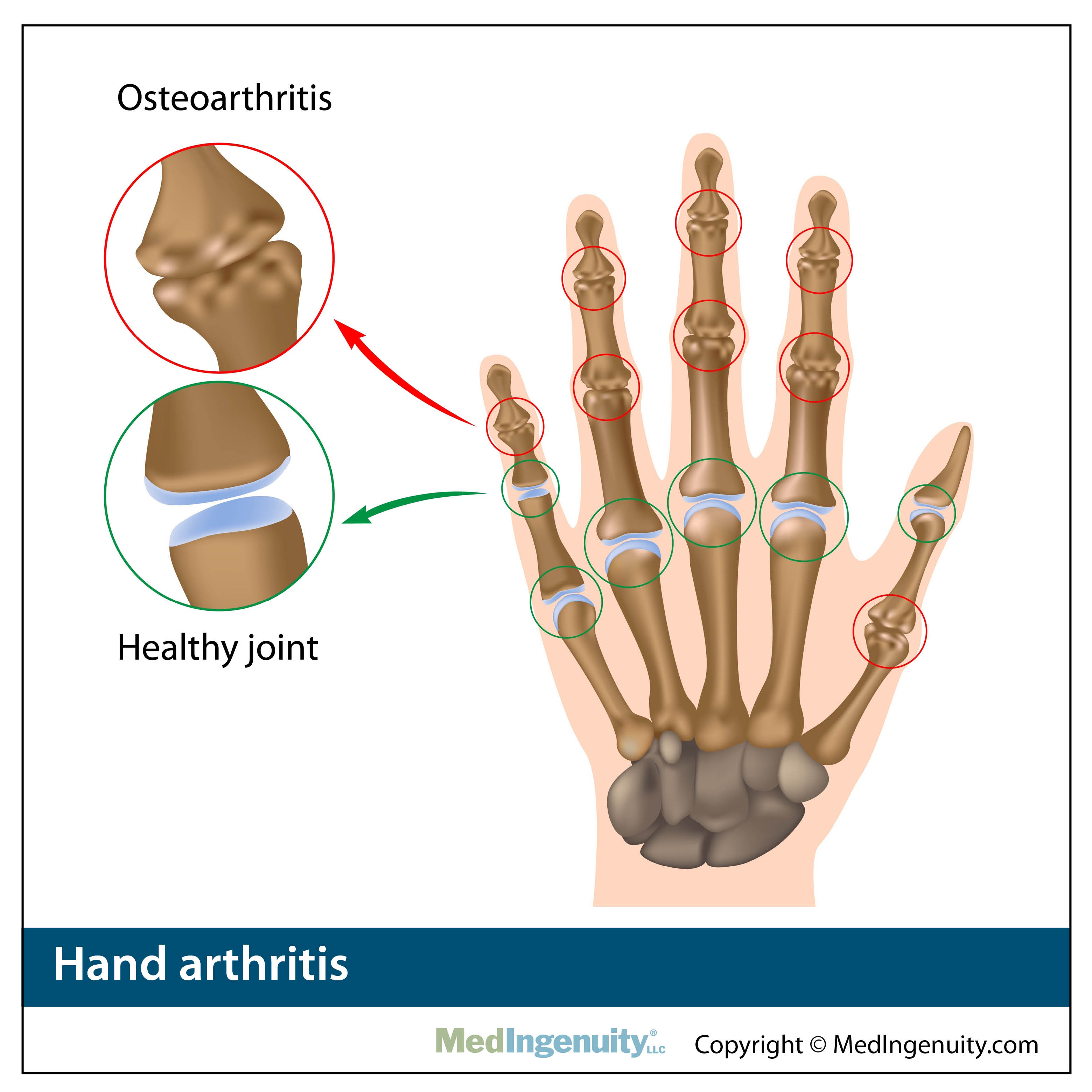 Hand arthritis anatomy 