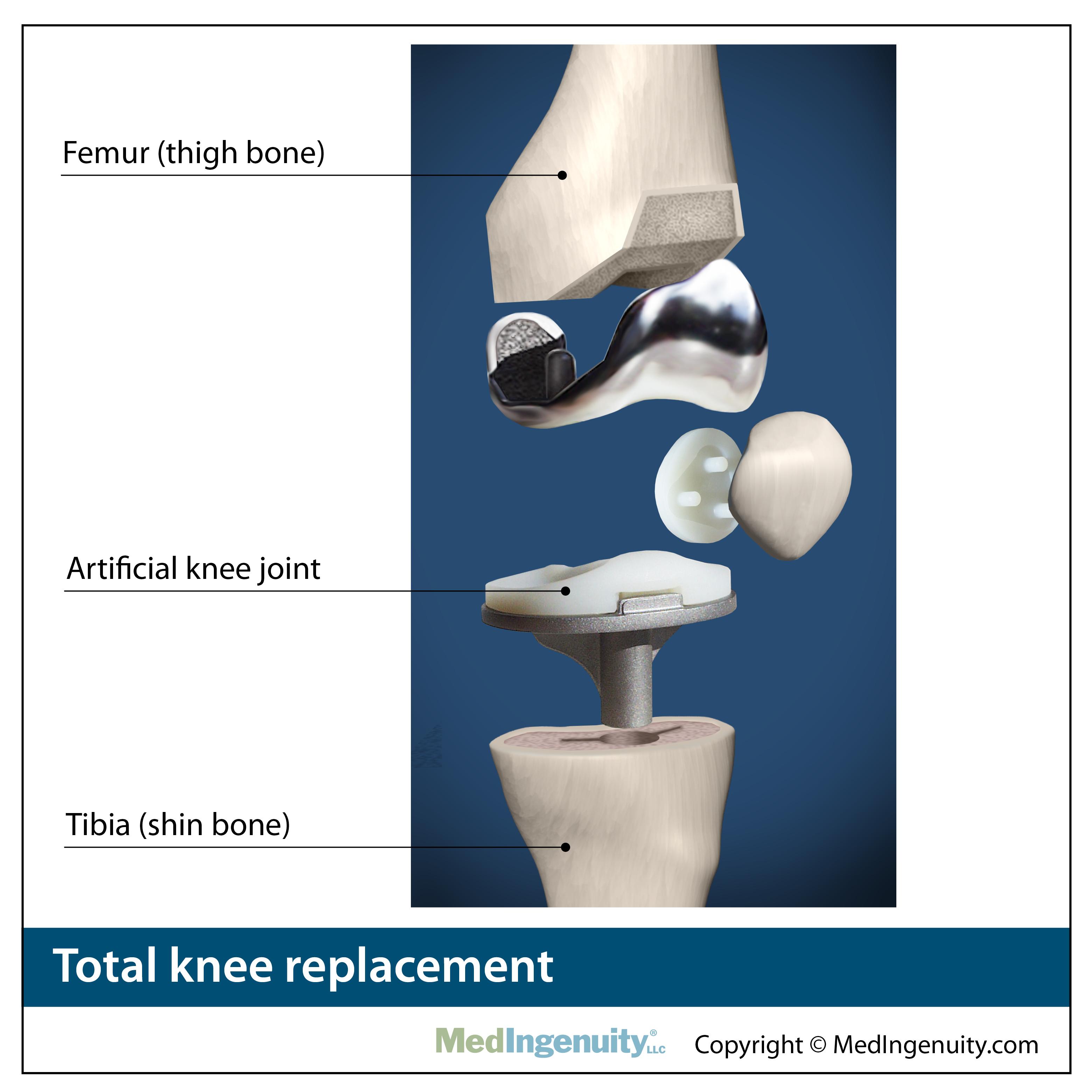 total knee replacement anatomy