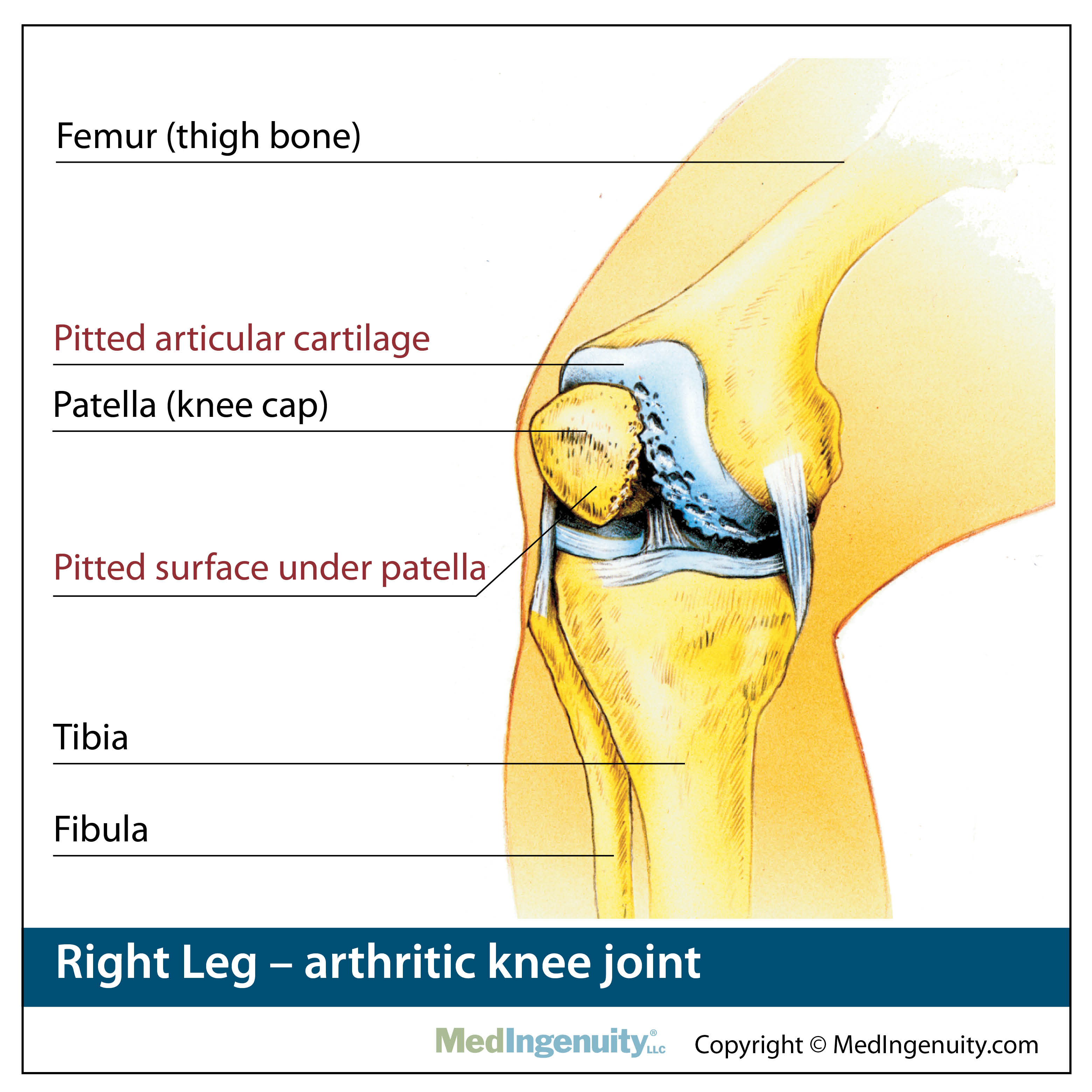 Arthritic Knee Joint anatomy