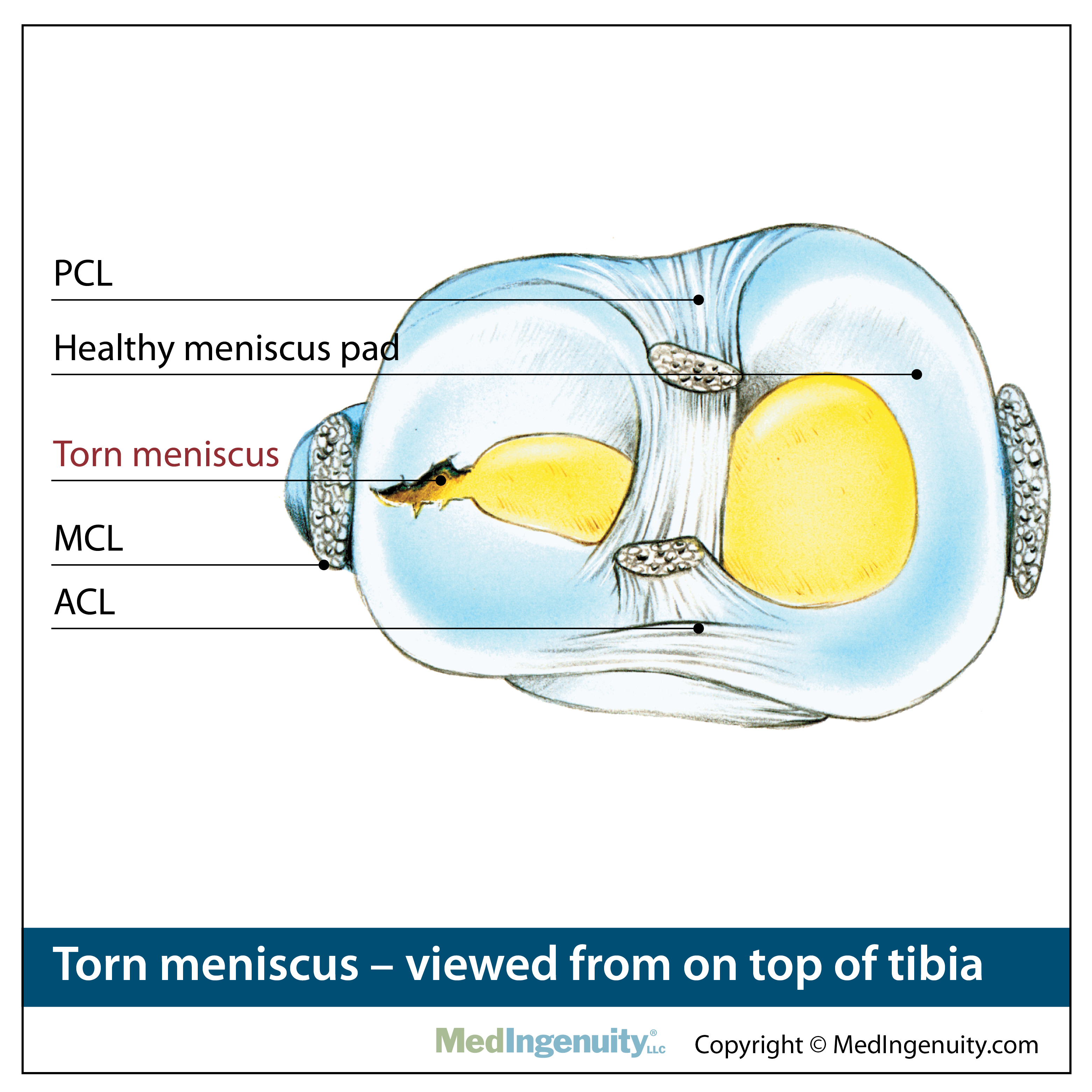 Torn Menicus anatomy 