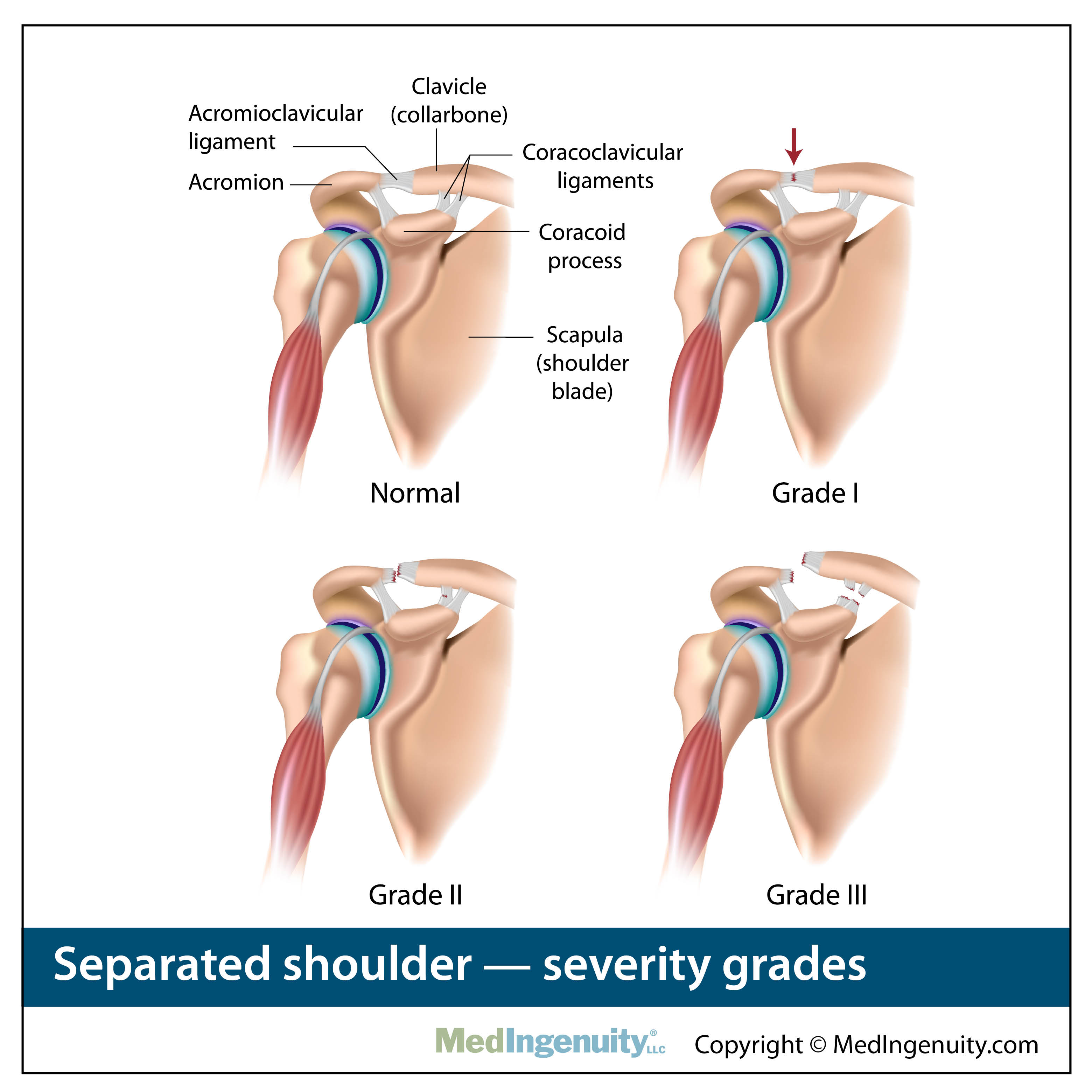 severity grades of separated shoulder anatomy