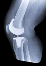 xray of knee replacement