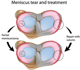 Meniscus tear and treatment