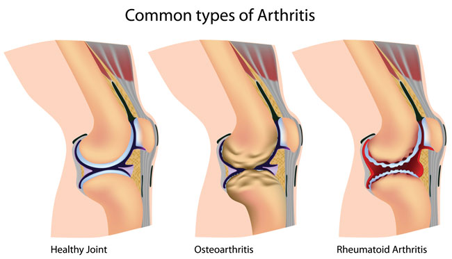 anatomy of healthy joint, osteoarthritis and rheumatoid arthritis
