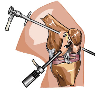 illustration of ACL repair