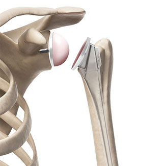 total joint replacement anatomy