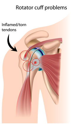 Inflamed/torn tendons