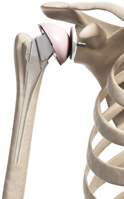 total joint replacement anatomy