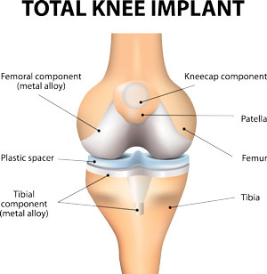 anatomy of knee implant