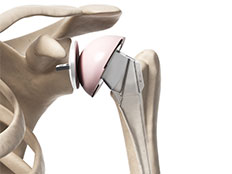 artificial shoulder joint anatomy